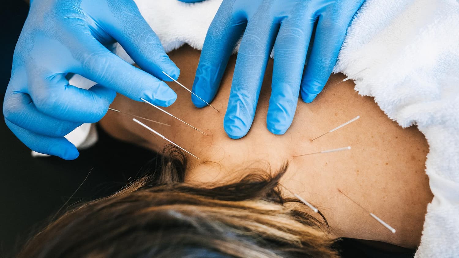 dry needles inserted into skin