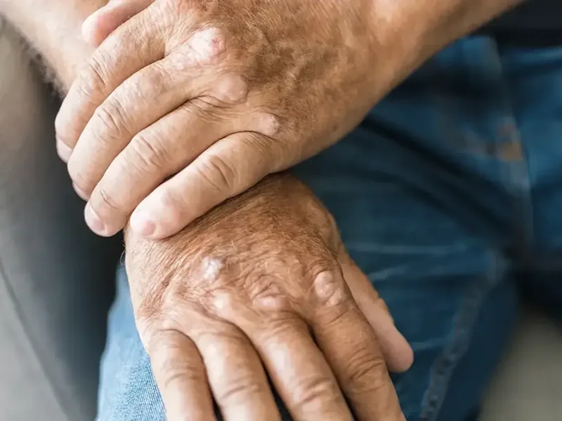 Arthritis treatment in Sachse