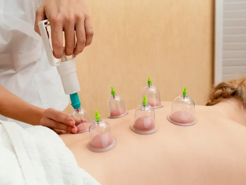 Cupping treatment in Wylie
