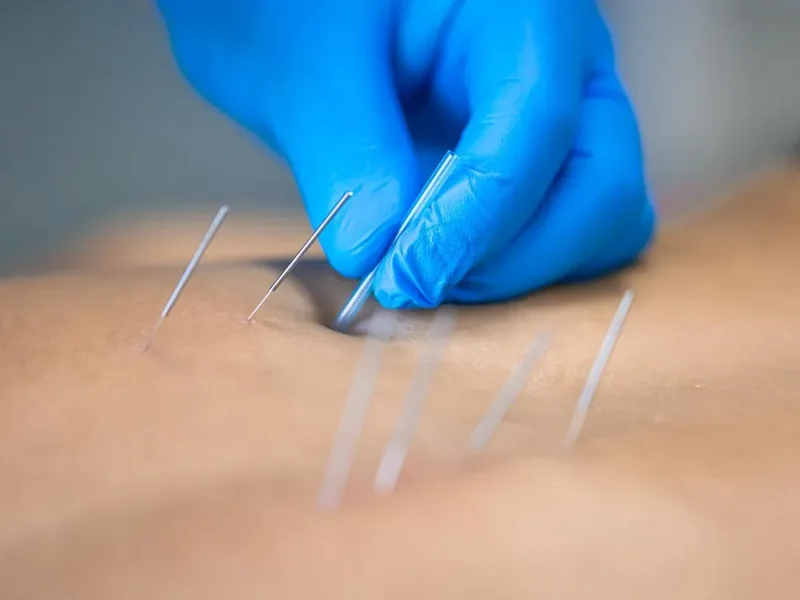 Dry Needling treatment in Wylie